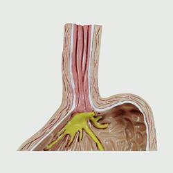 Gastroösophageale Refluxkrankheit 4-teilig mit GERD / Bild 4