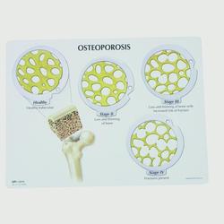 Osteoporose Knochenkrebs Scheibenset 4 Stadien / Bild 3