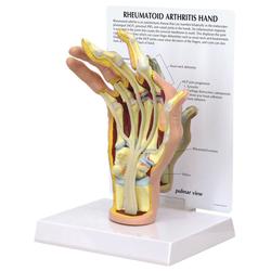 Handmodell mit rheumatoider Arthritis