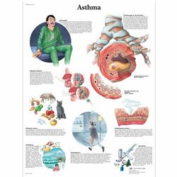 Lehrtafel - Asthma