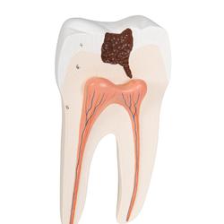 Unterer zweiwurzeliger Molar mit Karies / Bild 7