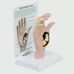 Modell einer Hand mit Osteoarthritis