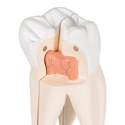 Oberer dreiwurzeliger Molar, 3- teilig / Bild 6