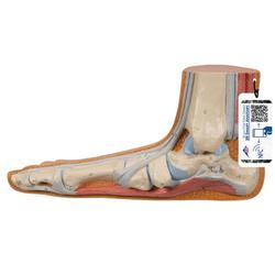 Fussmodell Plattfuss (Pes planus) - 3B Smart Anatomy