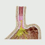 Gastroösophageale Refluxkrankheit 4-teilig mit GERD / Bild 2