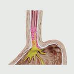 Gastroösophageale Refluxkrankheit 4-teilig mit GERD / Bild 3