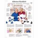 Lehrtafel - Alzheimer-Krankheit / Bild 1