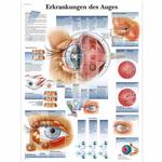 Lehrtafel - Erkrankungen des Auges / Bild 1