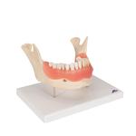 Zahnerkrankung Modell 2-fach vergrössert 21-teilig  / Bild 2