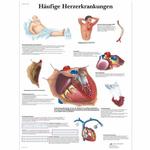 Lehrtafel - Häufige Herzerkrankungen / Bild 1