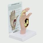 Modell einer Hand mit Osteoarthritis / Bild 1