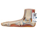 Fussmodell Plattfuss (Pes planus) - 3B Smart Anatomy / Bild 1